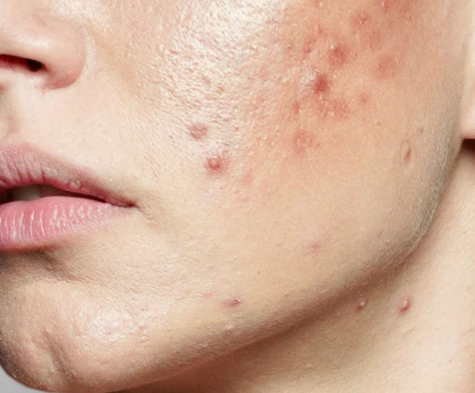 Varför bildas akne?